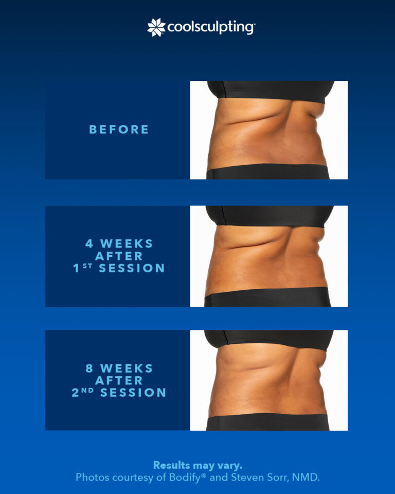 Understanding the CoolSculpting Process