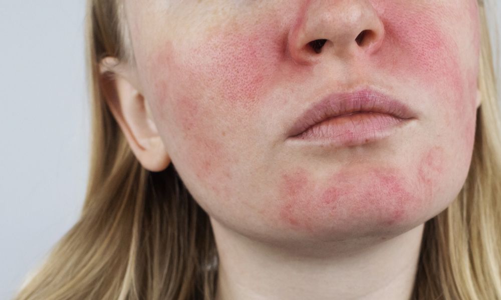 rosacea