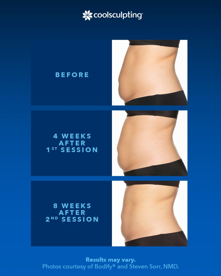 Understanding CoolSculpting: Will My Fat Come Back?