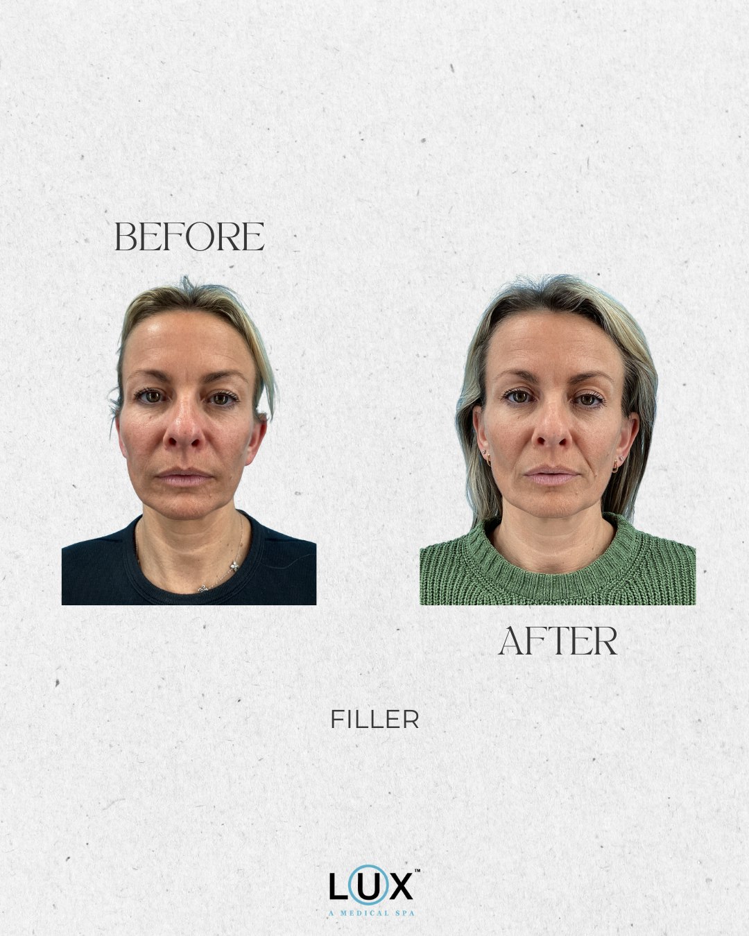 Smile lines around your eyes aren’t aging you. They’re just making you look a little more tired than you actually are.
A lot of women come to us nervous about filler, and honestly, we get it. The internet has not been kind in showing what filler can look like. But that’s not what we do here. ✨
@kylienp_luxamedicalspa did this treatment, and what you’re seeing is what natural, soft filler actually looks like in the right hands: no puffiness, nothing overdone, just a quieter, more rested version of the same face you’ve always had.
DM us or book through the link in our bio! Kylie would love to walk you through it and answer every question you have.