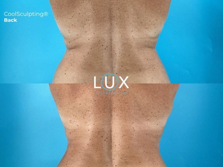 Struggling With Stubborn Fat? What to Know Before Your First CoolSculpting Treatment