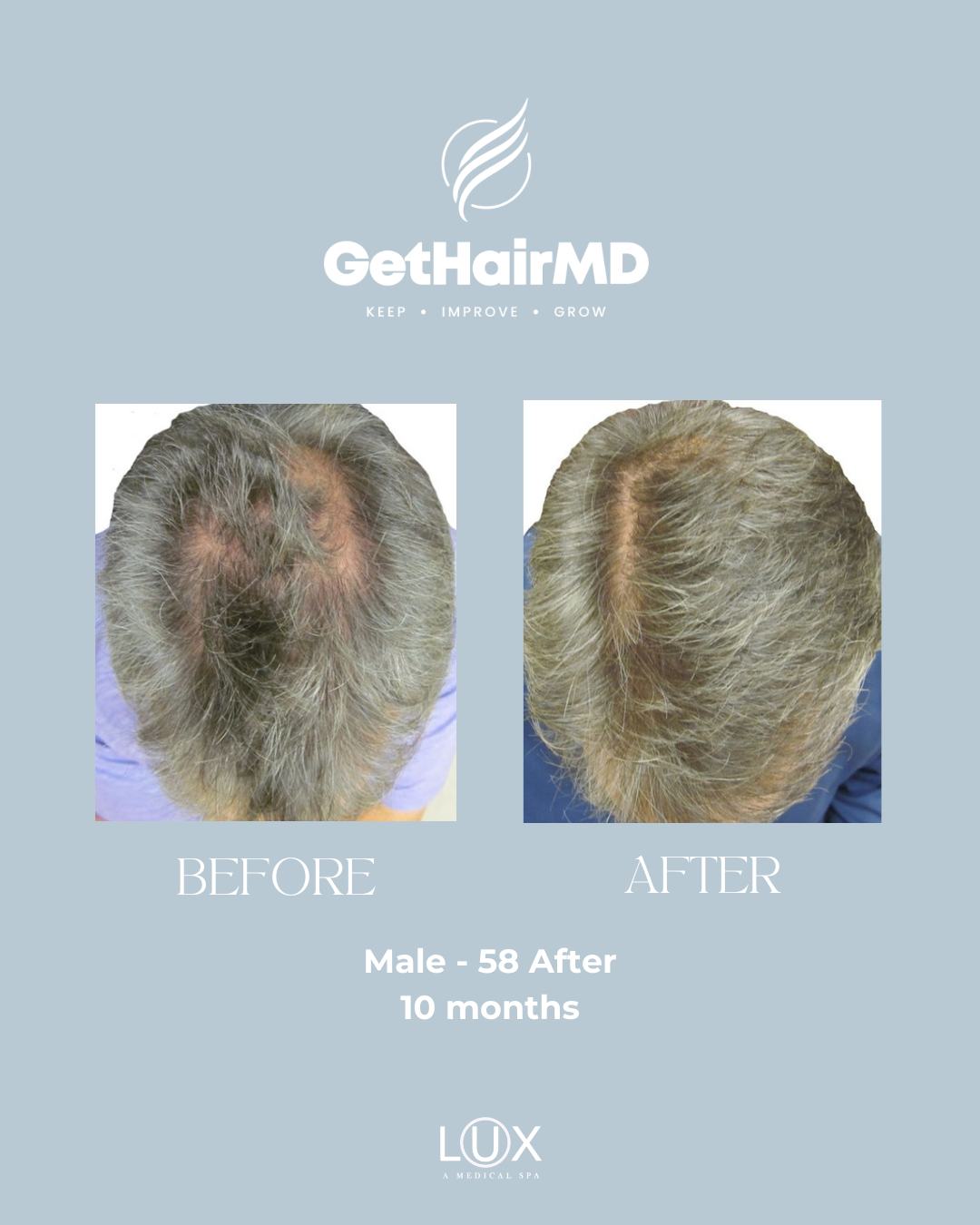 10 months. One transformation. Real hair restoration results.

This before-and-after is proof that thinning hair and hair loss can be treated with the right professional care and consistency.

At LUX ~A Medical Spa, our @gethairmd hair restoration treatments are designed for both men and women experiencing:

• Hair thinning
• Receding hairlines
• Excessive shedding
• Loss of density and fullness

And yes, dads too. 👨‍👧‍👦

This Father’s Day, give Dad something deeper than a gift: renewed confidence.

Serving Bluffton, Hilton Head, and Beaufort, SC, LUX Medical Spa offers advanced, non-surgical hair restoration solutions customized for every stage of hair loss.

Book a consultation through the link in bio.