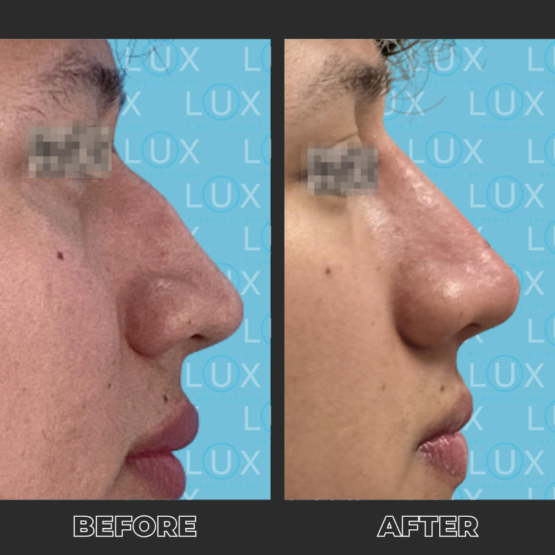 36188 - Non Surgical Rhinoplasty