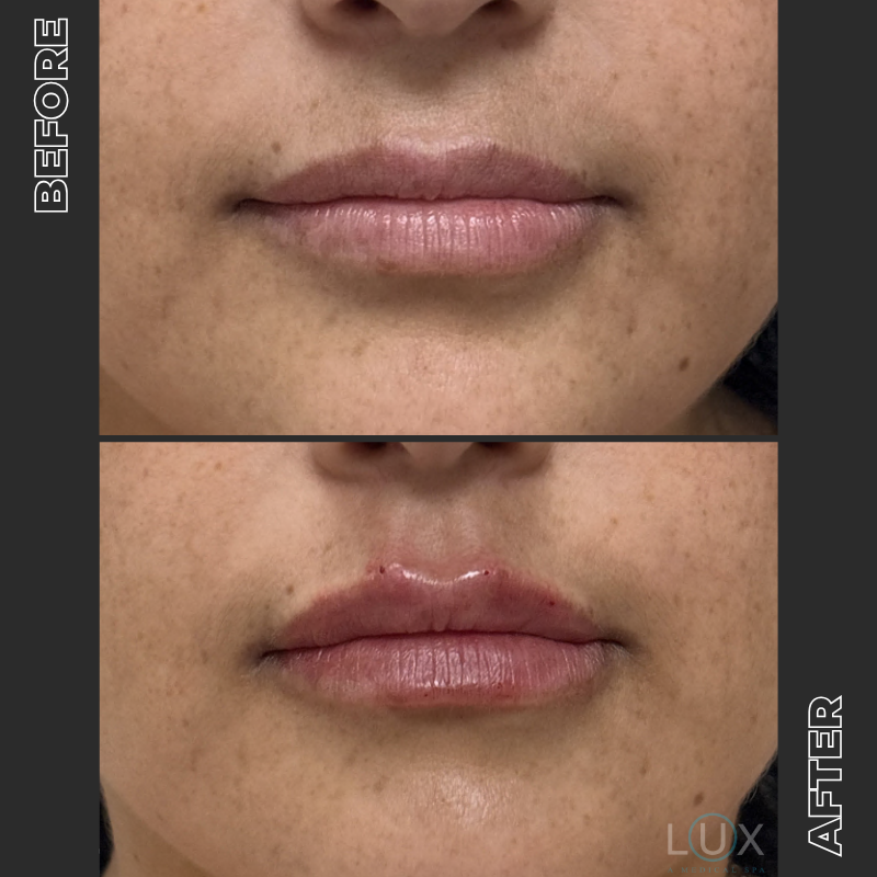 36010 - Lip Filler