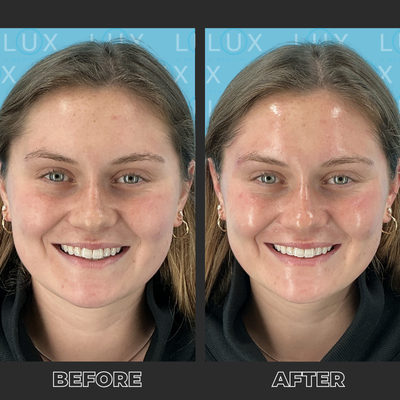 Before-and-after images were taken immediately following a Signature Hydrafacial combined with dermaplaning.